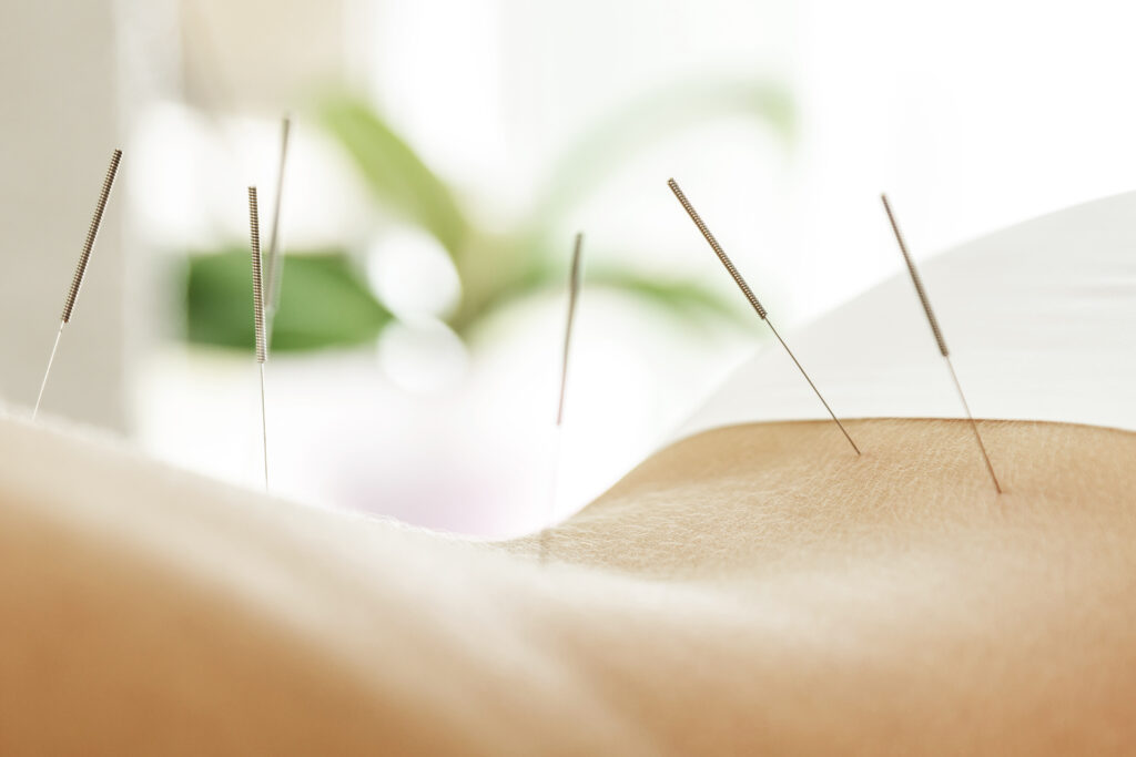 Rücken einer Frau mit Akupunktur Nadeln der Naturheilkunde